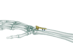 Distal Ulna Anatomik Plak - Görsel 2