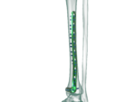 Distal Tibia Anterolateral Anatomik Plak - Görsel 2