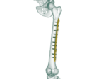 4.5mm Femur Broad Düz Plak