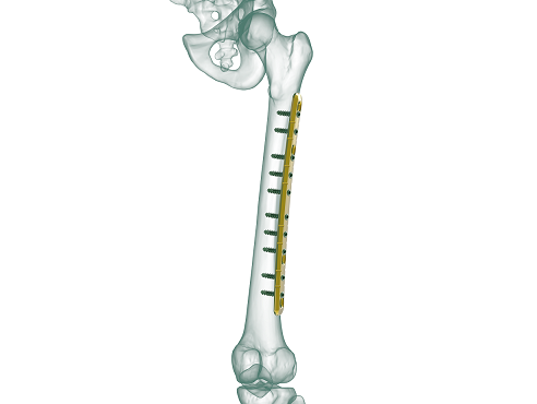 3-min2 4.5mm Femur Broad Düz Plak - Görsel 1