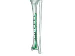 Distal Tibia Anterolateral Anatomik Plak - Görsel 3