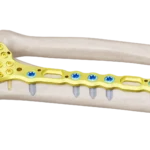 Distal Radius Volar Anatomik Plak