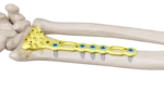 Distal Radius Volar Anatomik Plak