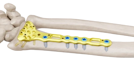 Distal Radius Volar Anatomik Plak