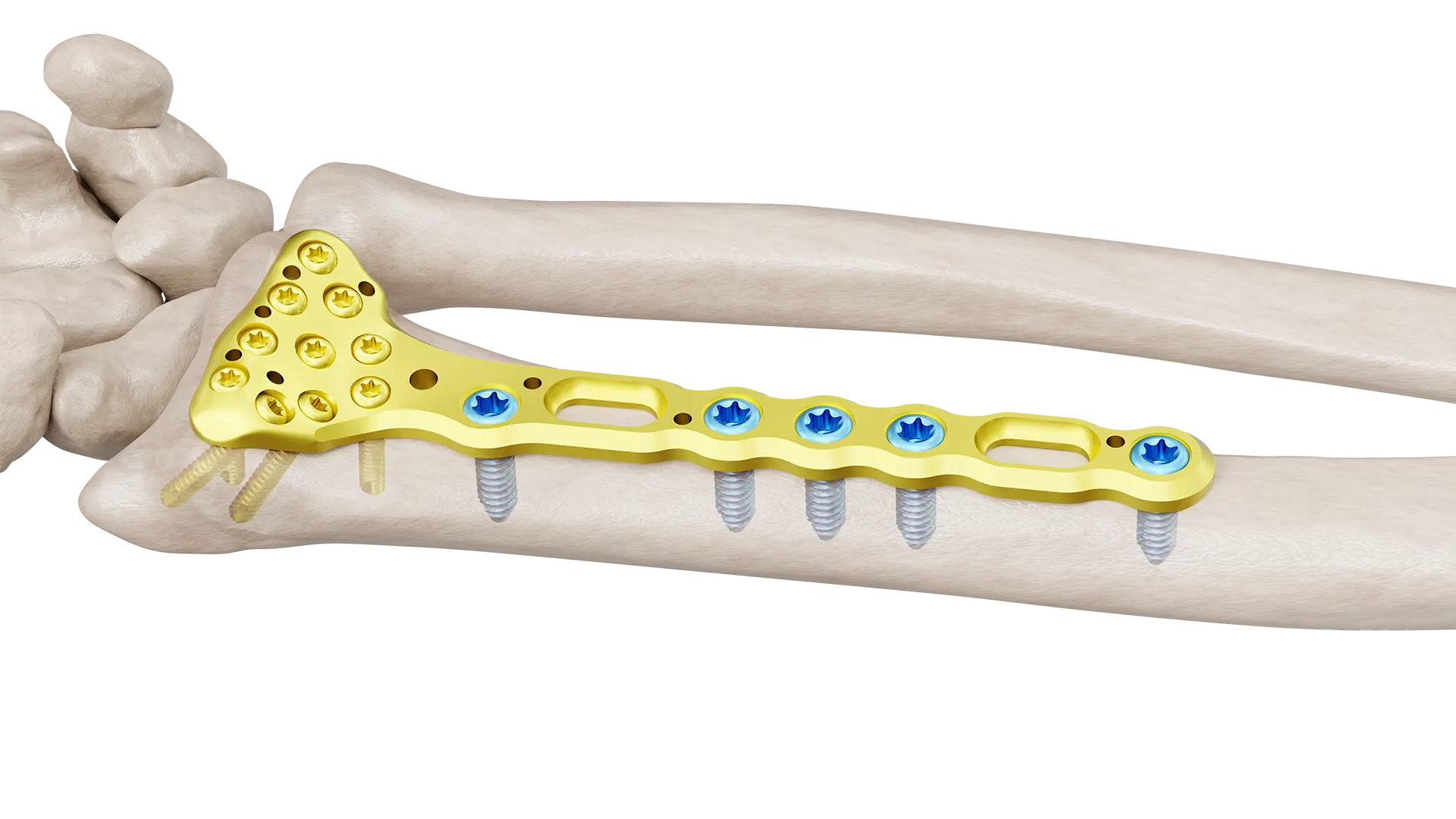 DRVAS NEW01 Distal Radius Volar Anatomik Plak - Görsel 1