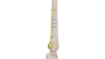 Distal Radius Volar Anatomik Plak - Görsel 3