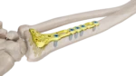 Distal Radius Volar Anatomik Plak - Görsel 2