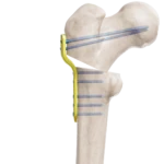 Pediatrik Kalça Proksimal Femur Plak
