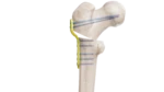 Pediatrik Kalça Proksimal Femur Plak