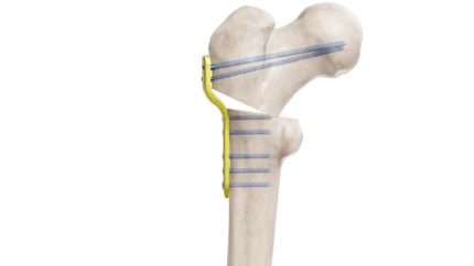 Pediatrik Kalça Proksimal Femur Plak
