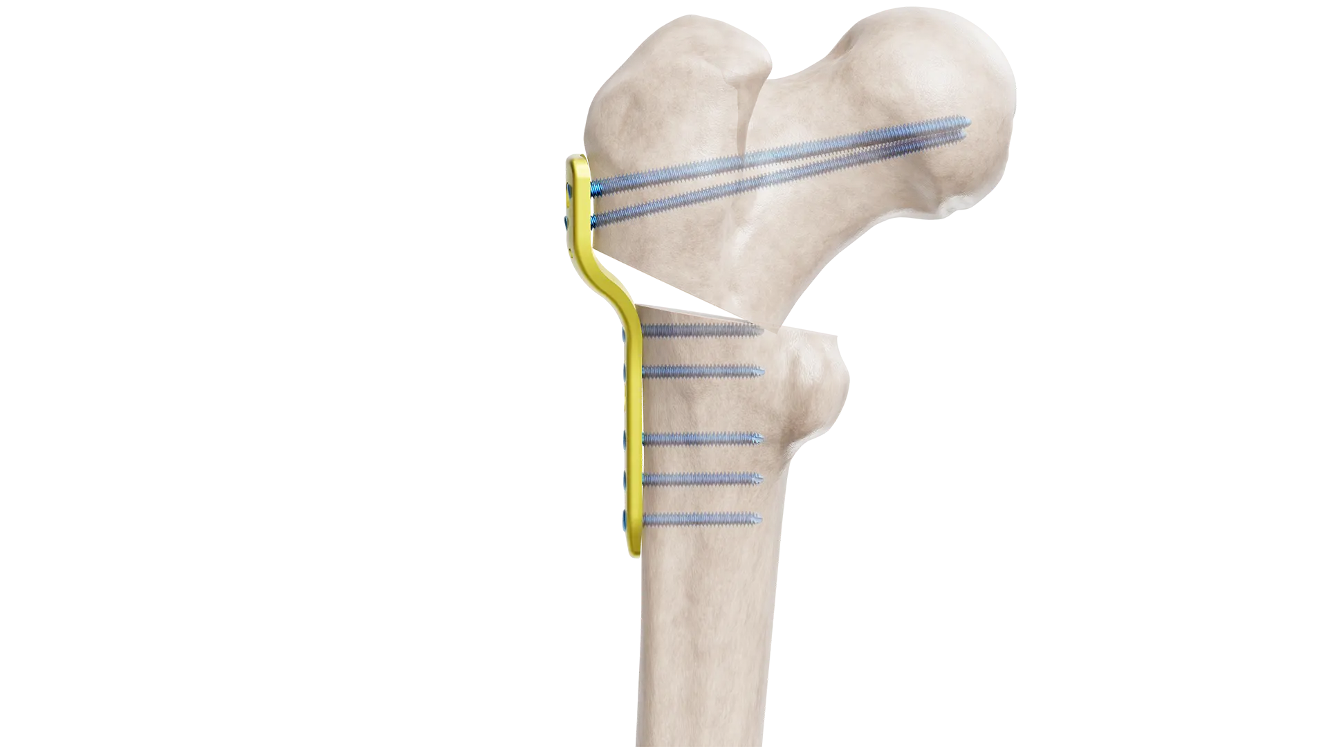 TF04 PHPF R01A2X Pediatrik Kalça Proksimal Femur Plak - Görsel 1
