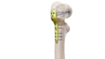 Pediatrik Kalça Proksimal Femur Plak - Görsel 2