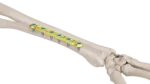 3.5mm Lcdpc Ulna, Radius Plak - Görsel 2