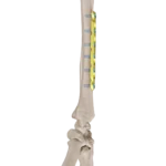 3.5mm Lcdpc Ulna, Radius Plak