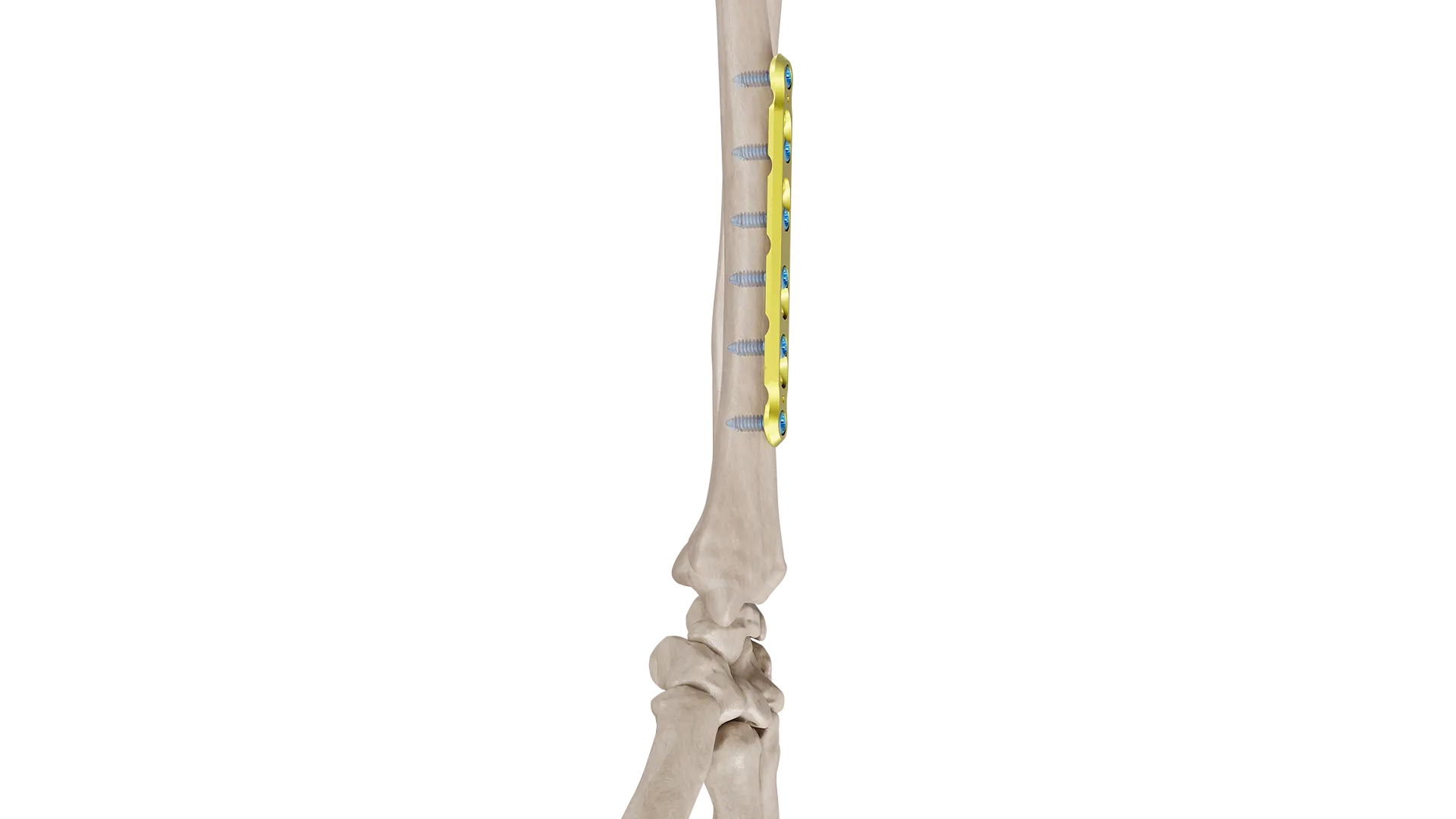 UR NEW02 3.5mm Lcdpc Ulna, Radius Plak - Görsel 1