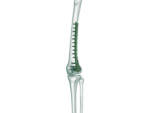 Distal Femur Lateral Anatomik Plak - Görsel 2