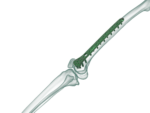 Distal Femur Lateral Anatomik Plak - Görsel 3