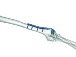 Distal Humerus Lateral Anatomik Plak - Görsel 2