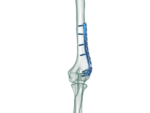 Distal Humerus Lateral Anatomik Plak - Görsel 3