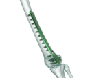 Distal Femur Lateral Anatomik Plak
