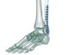 Distal Fibula Lateral Plak