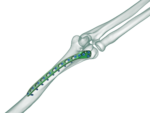 Distal Humerus Posterolateral Anatomik Plak - Görsel 2