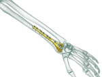 Distal Radius Dorsal Anatomik Plak