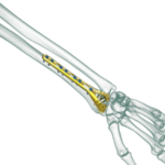 Distal Radius Dorsal Anatomik Plak