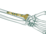 Distal Radius Volar Anatomik Plak