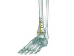 Distal Tibia Anterior Anatomik Plak