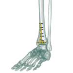 Distal Tibia Anterior Anatomik Plak
