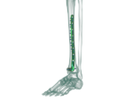 Distal Tibia Anterolateral Anatomik Plak