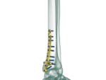 Distal Tibia Medial Malleolar Anatomik Plak