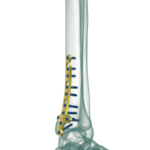 Distal Tibia Medial Malleolar Anatomik Plak