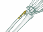 Distal Ulna Anatomik Plak