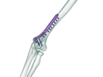 Distal Humerus Medial Plak