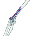 Distal Humerus Medial Plak