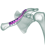 Klavikula Anatomik Plak