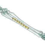 3.5mm Lcdpc Ulna, Radius Plak