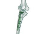 4.5mm Proksimal Tibia Lateral Anatomik Plak