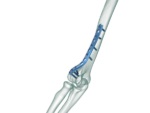Distal Humerus Lateral Anatomik Plak