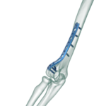 Distal Humerus Lateral Anatomik Plak