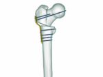 Pediatrik Kalça Proksimal Femur Plak