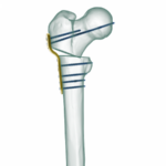 Pediatrik Kalça Proksimal Femur Plak