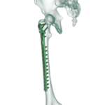 Proksimal Femur Lateral Anatomik Plak