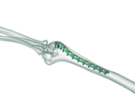 Distal Humerus Posterolateral Anatomik Plak