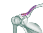 Superior Distal Klavikula Anatomik Plak