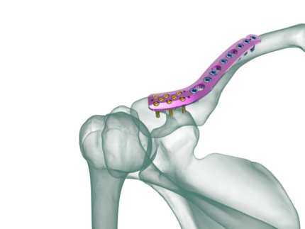 Superior Distal Klavikula Anatomik Plak