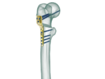 Pediatrik Kalça Proksimal Femur Plak - Görsel 2