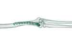 Distal Humerus Posterolateral Anatomik Plak - Görsel 3